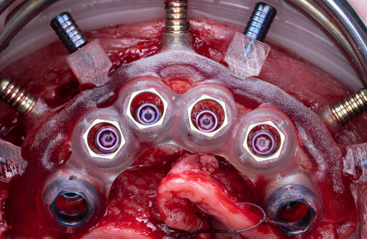 Cirugía guiada All-on-X con implantes dentales
